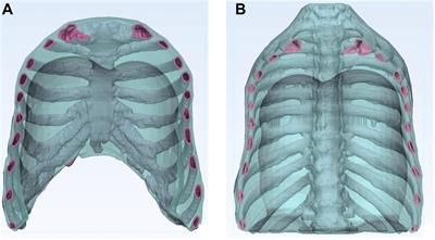 Additively Manufactured Patient-Specific Anthropomorphic Thorax Phantom With Realistic Radiation Attenuation Properties